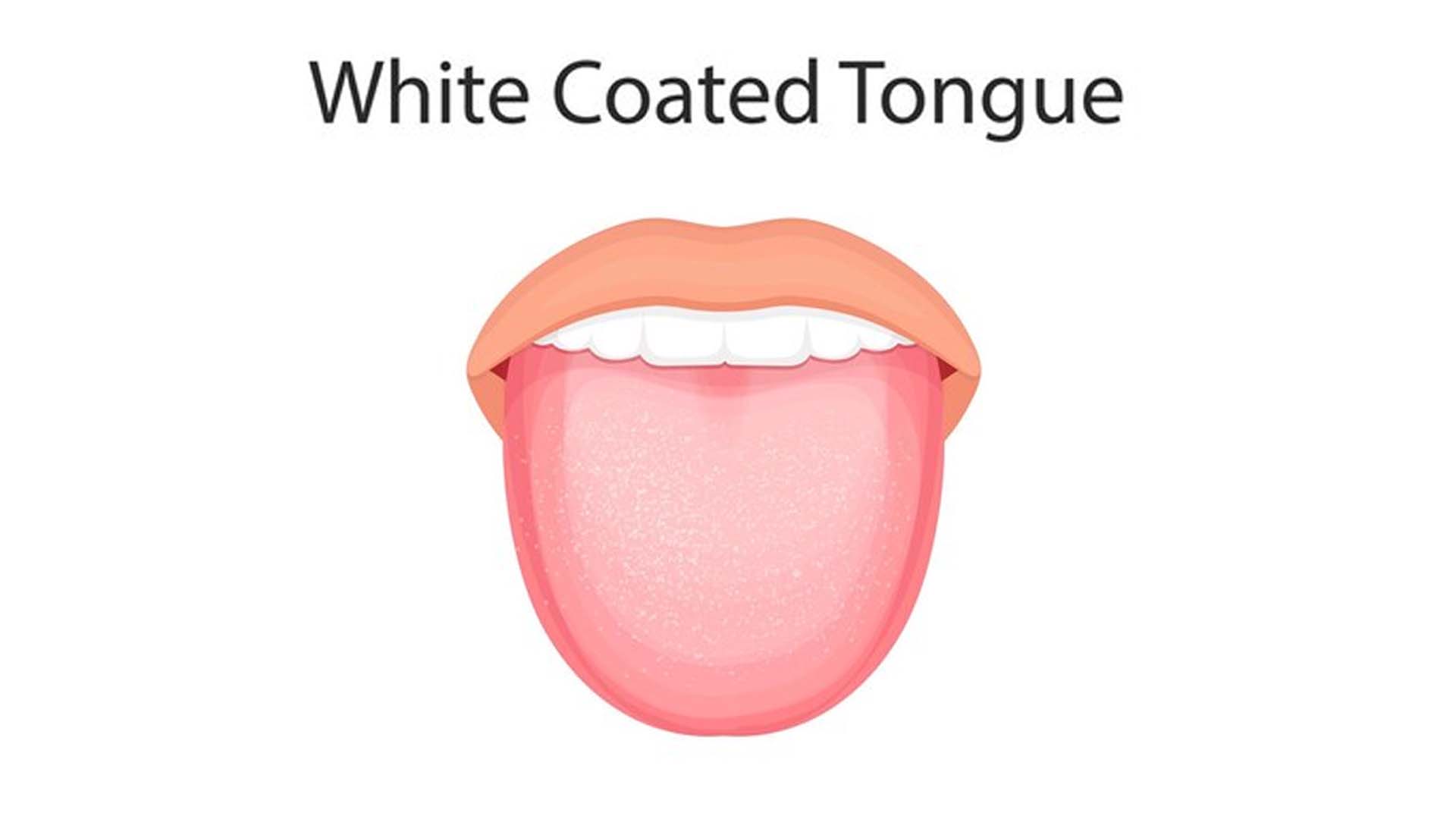 White Tongue