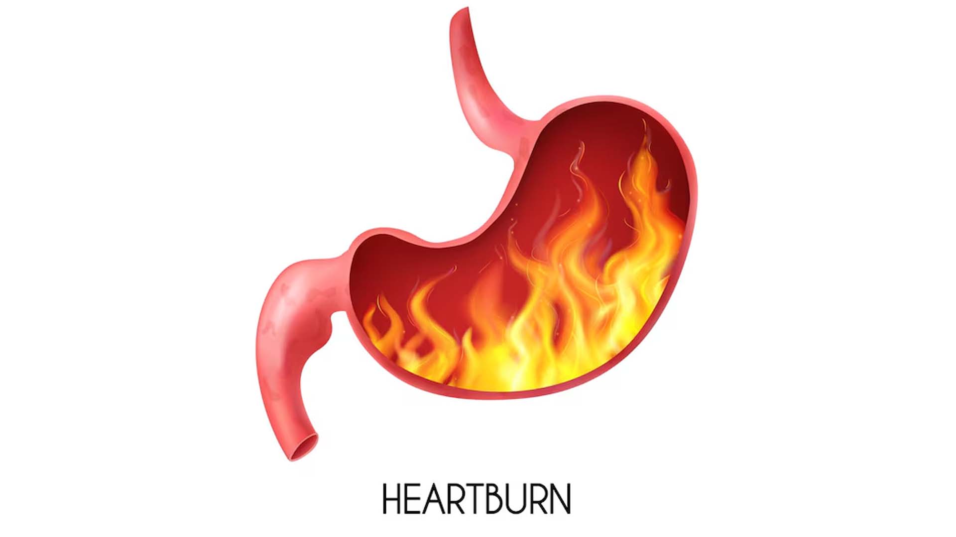 Heartburn