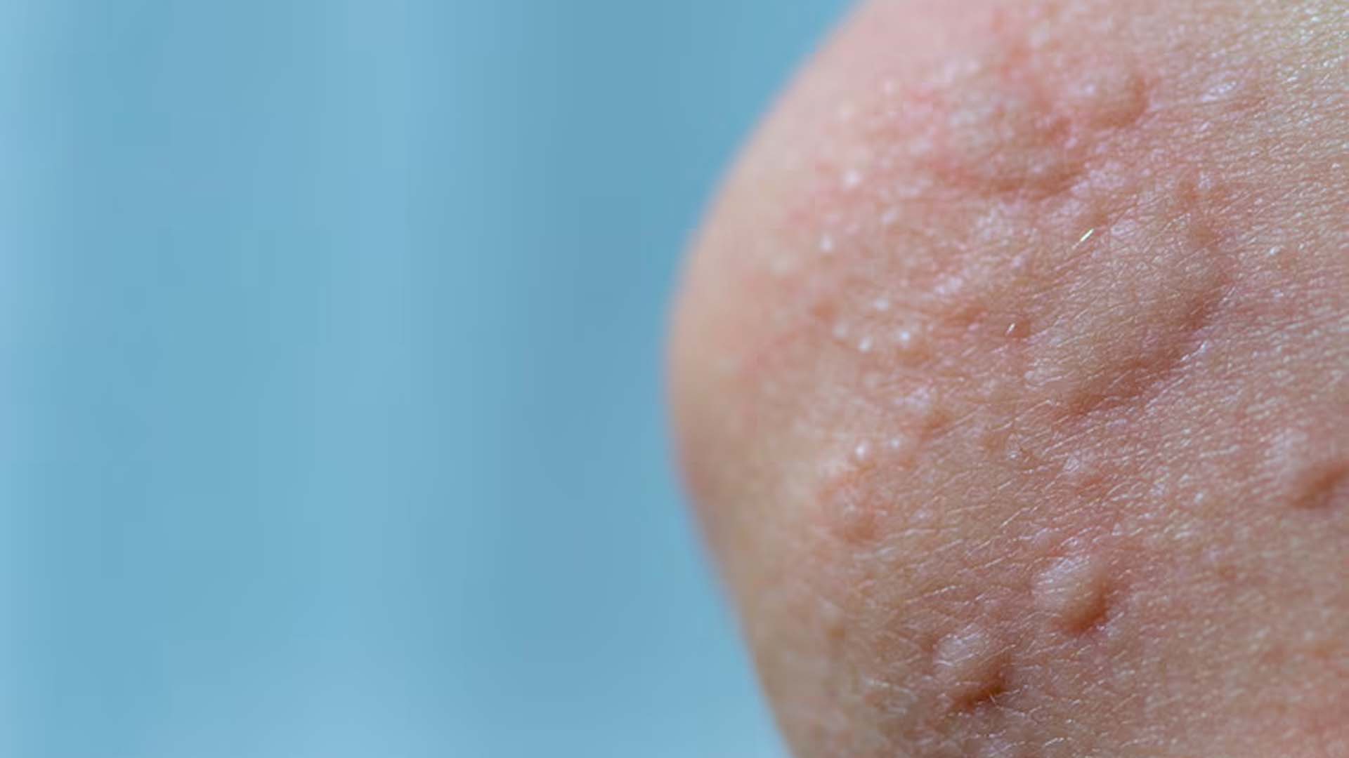 Hives (urticaria)