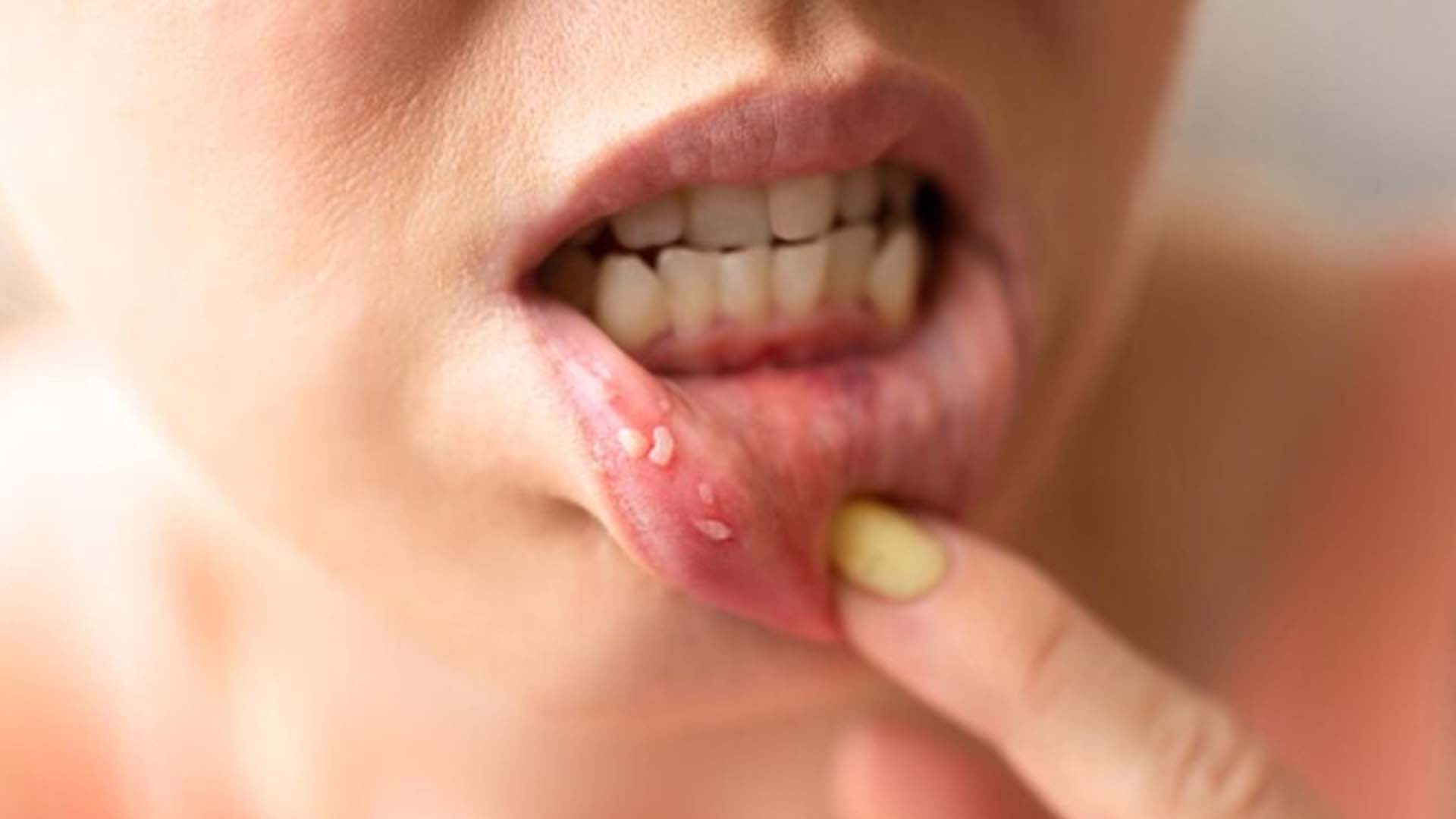 Mouth Ulcers