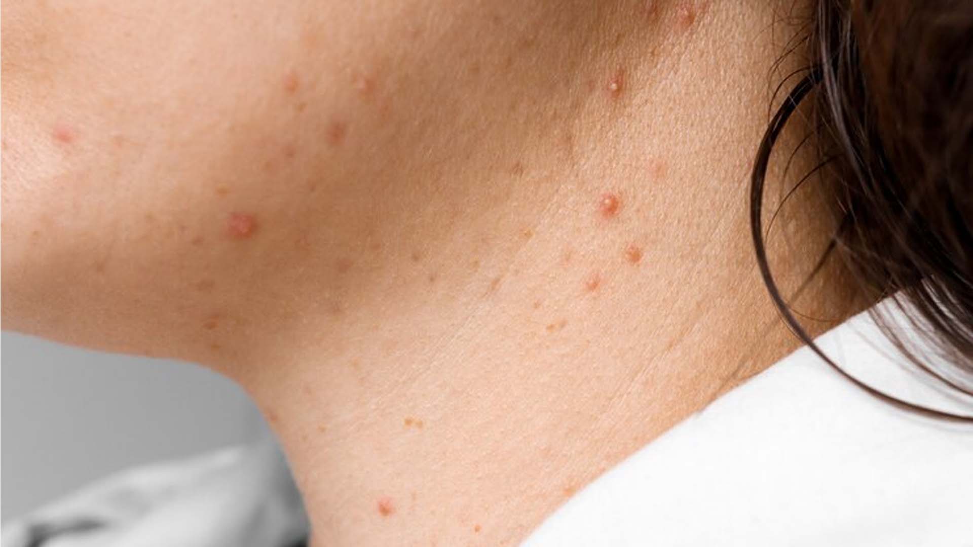 Pimples